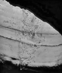 Figure 2. Severe erosion of the slag line in the ladle